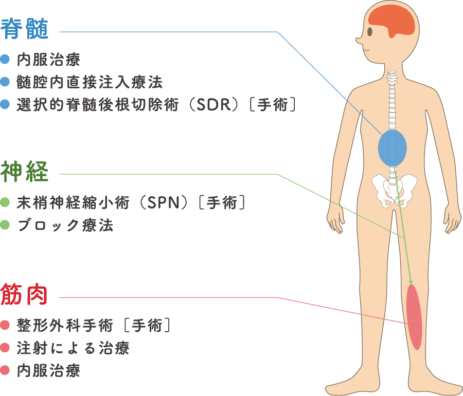 脊髄：内服治療、髄腔内直接注入療法、選択的脊髄後根切除術（SDR）。神経：末梢神経縮小術（SPN）、ブロック療法。筋肉：整形外科手術、注射による治療、内服治療。